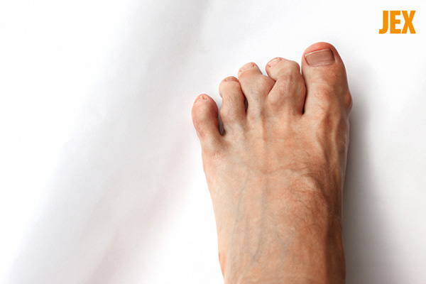 Các đốt ngón chân bị biến dạng do viêm khớp