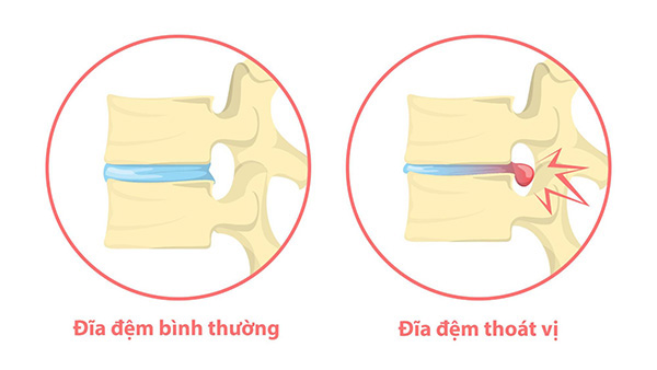 Nguyên nhân đau thắt lưng ở nam giới