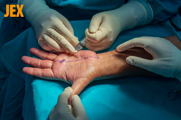 Điều trị ngón tay cò súng
