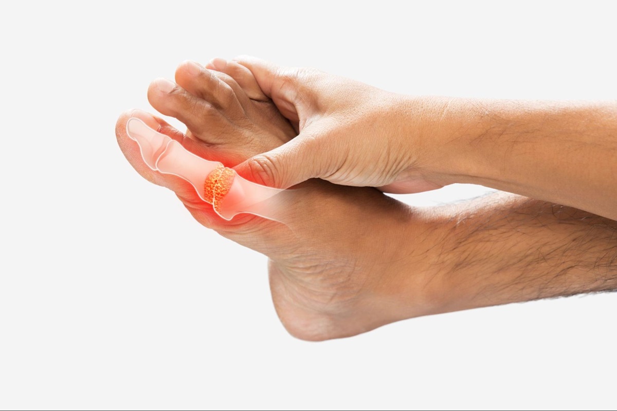 Bệnh gout khiến cơn đau khớp trở nặng hơn khi thay đổi thời tiết