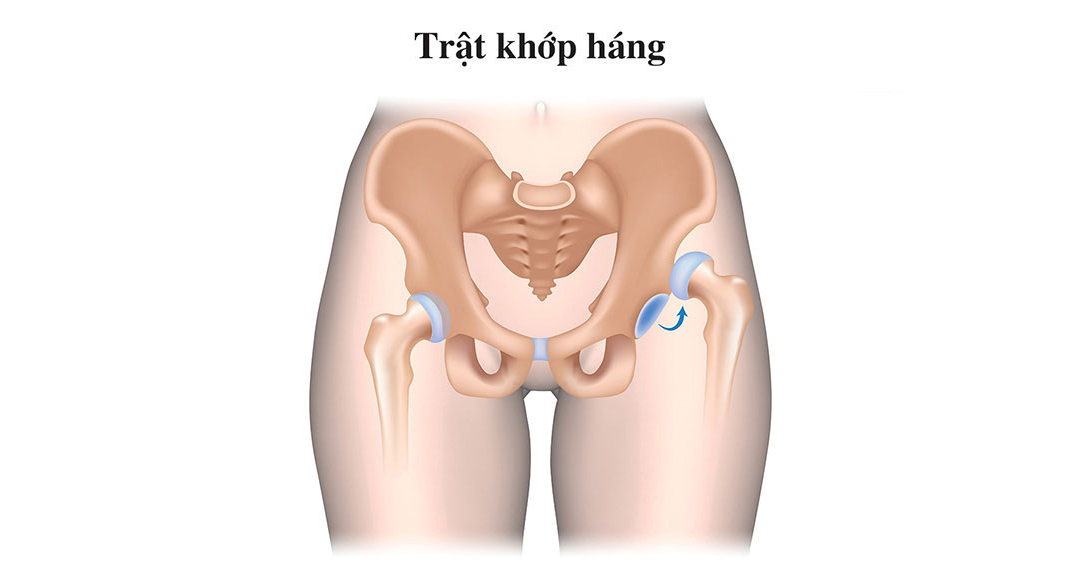 Trật khớp háng