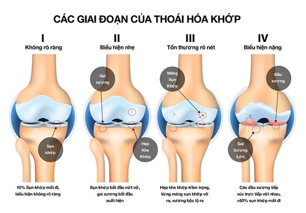 Các giai đoạn của thoái hóa khớp gối