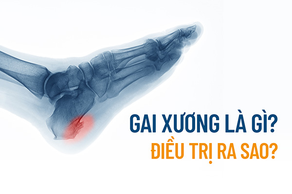 Gai xương (xương mọc gai): Nguyên nhân, dấu hiệu và cách điều trị