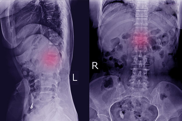 Thoái hóa đốt sống ngực: Nguyên nhân, triệu chứng và cách điều trị