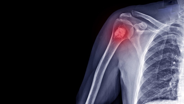 Ung thư xương là gì? Nguyên nhân, dấu hiệu và cách điều trị