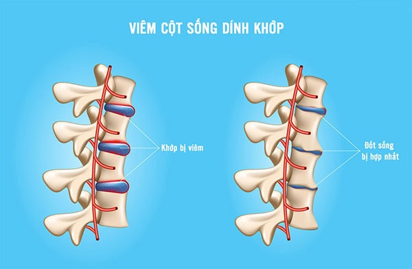 Bị viêm cột sống dính khớp