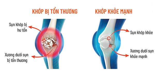 Chăm sóc sụn khớp
