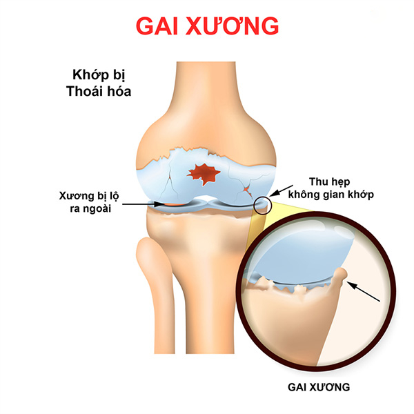 Gai xương