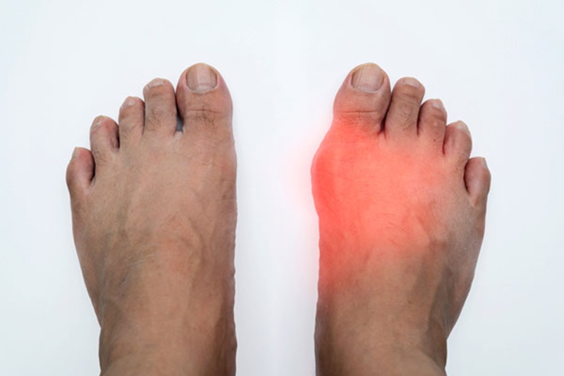 Thoái hóa khớp ở bàn chân, ngón chân