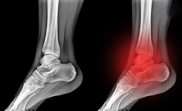 Nguyên nhân thoái hóa cổ chân
