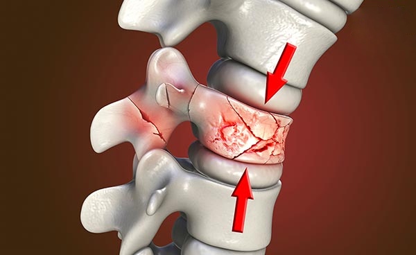 Xẹp đốt sống lưng D12: Nguyên nhân, dấu hiệu và cách điều trị