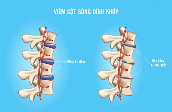 Viêm cột sống dính khớp: Nguyên nhân, dấu hiệu và cách điều trị