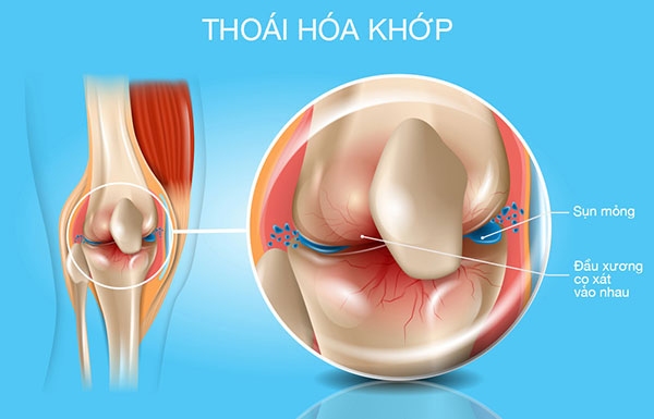 Nguyên nhân gây viêm cột sống dính khớp