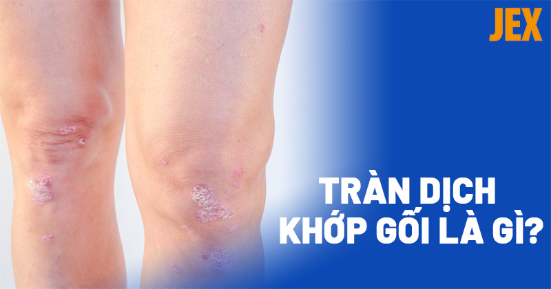 Tràn dịch khớp gối: Nguyên nhân, dấu hiệu và cách cải thiện
