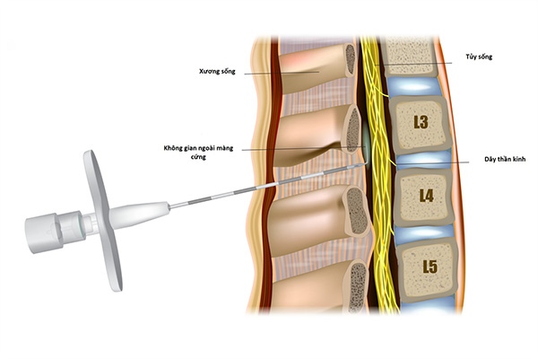 Phương pháp tiêm ngoài màng cứng