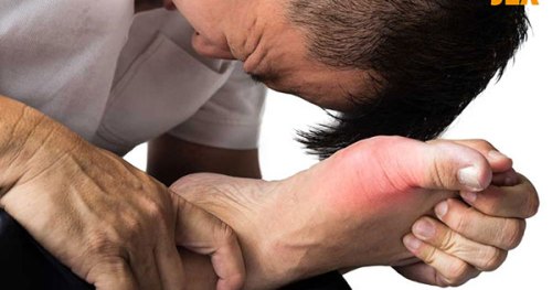 Bệnh gout (gút) – Nguyên nhân, chẩn đoán và điều trị