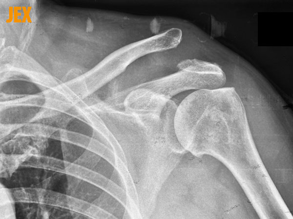 Trật khớp cùng đòn: Nguyên nhân, dấu hiệu và cách điều trị