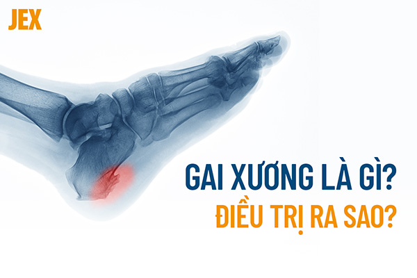 Gai xương (xương mọc gai): Nguyên nhân, dấu hiệu và cách điều trị