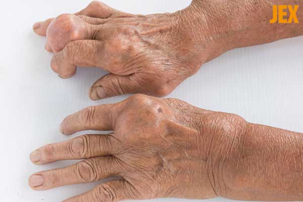 Những biến chứng nguy hiểm của bệnh Gout