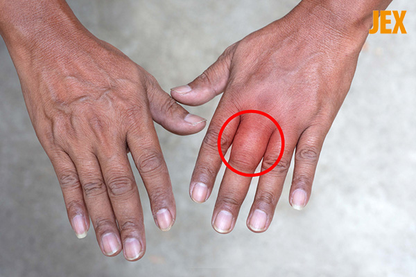 Ngón tay bị sưng là bệnh gì? Nguyên nhân, dấu hiệu