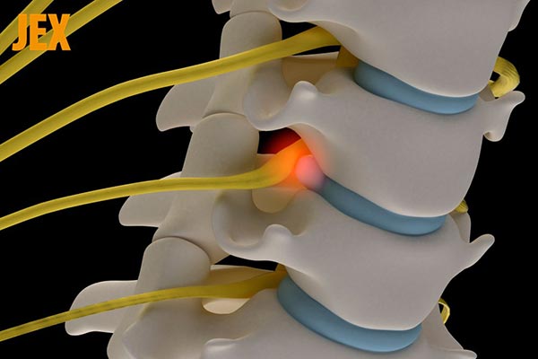 Đốt sống cổ bị lồi (phình): Nguyên nhân, dấu hiệu, cách khắc phục