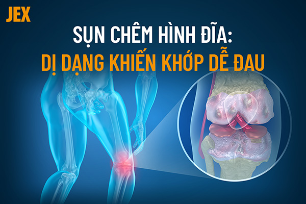 Sụn chêm hình đĩa: Yếu tố gây đau khớp gối ít người biết