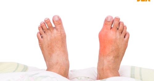Viêm khớp ngón chân: Nguyên nhân, dấu hiệu và cách cải thiện
