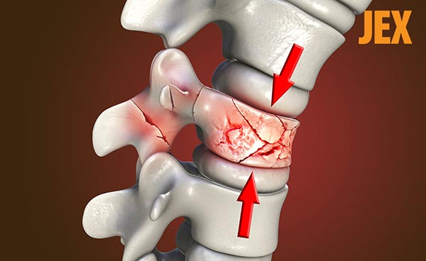 Xẹp đốt sống lưng D12: Nguyên nhân, dấu hiệu và cách điều trị
