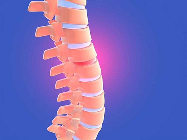 Tổn thương đĩa đệm do gai cột sống
