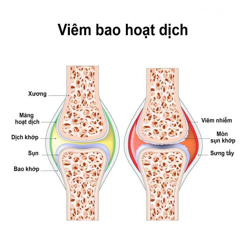 Nguyên nhân gây sưng đầu gối