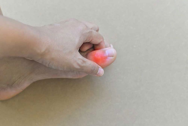Triệu chứng bệnh gout
