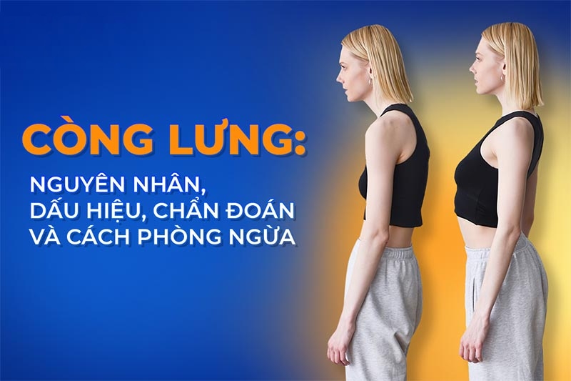 Còng lưng: Nguyên nhân, dấu hiệu, chẩn đoán và cách phòng ngừa