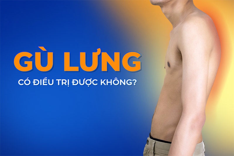 Gù lưng là gì? Nguyên nhân, dấu hiệu, cách phòng ngừa