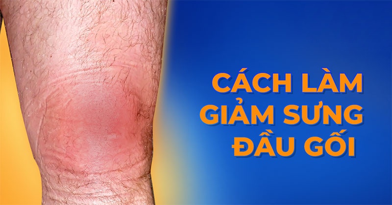 8 cách làm giảm sưng đầu gối hiệu quả, dễ thực hiện tại nhà