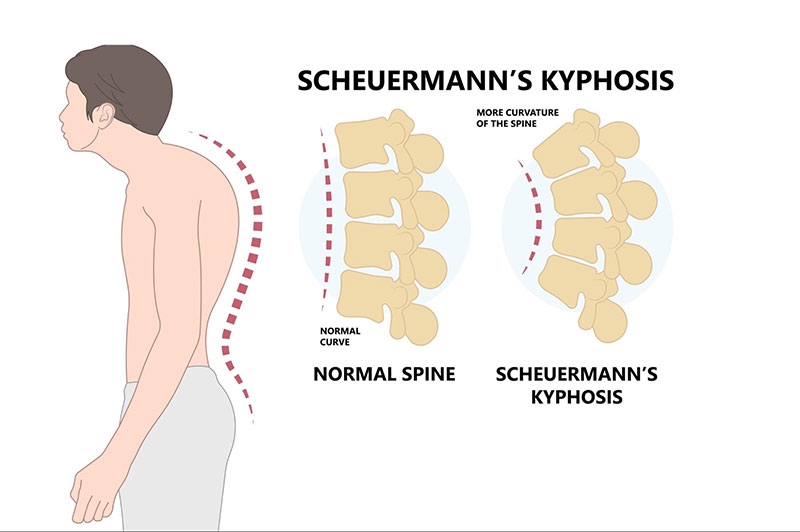 Còng lưng cột sống Scheuermann
