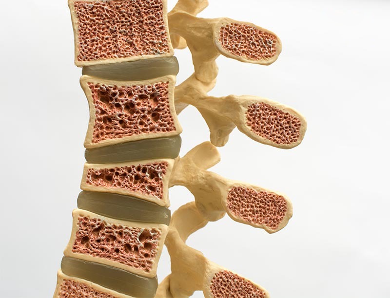 Gãy xẹp đốt sống gây gù lưng