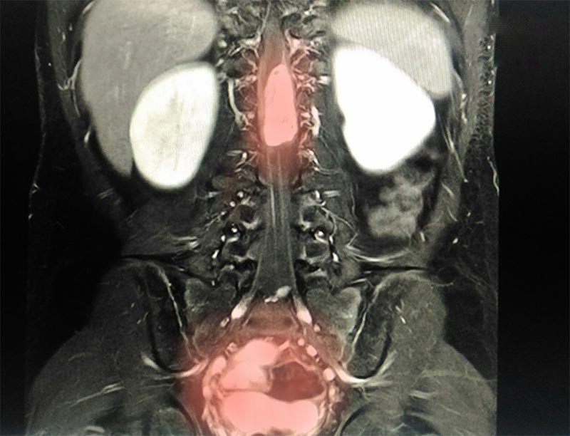 Khối u là một nguyên nhân gây gù lưng