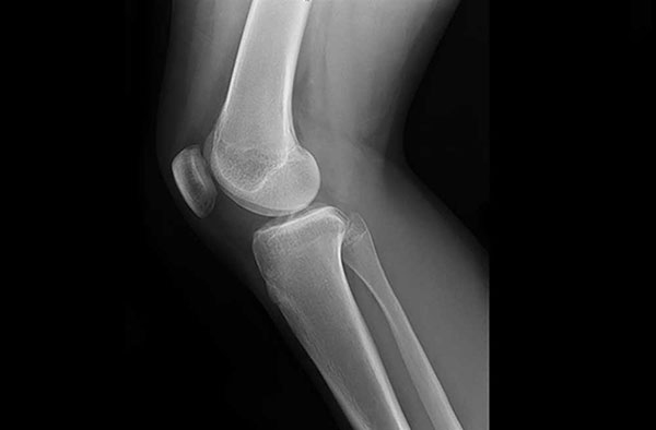 Cách chẩn đoán lỏng khớp gối