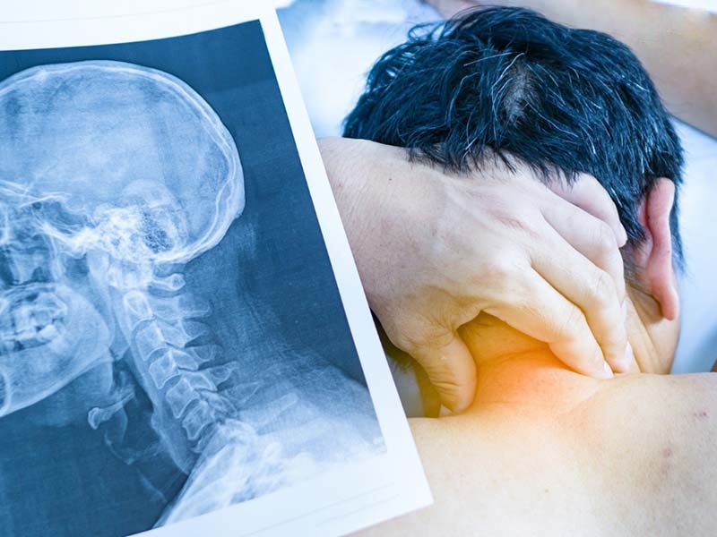 Cách chẩn đoán thoái hóa đốt sống cổ gây đau đầu