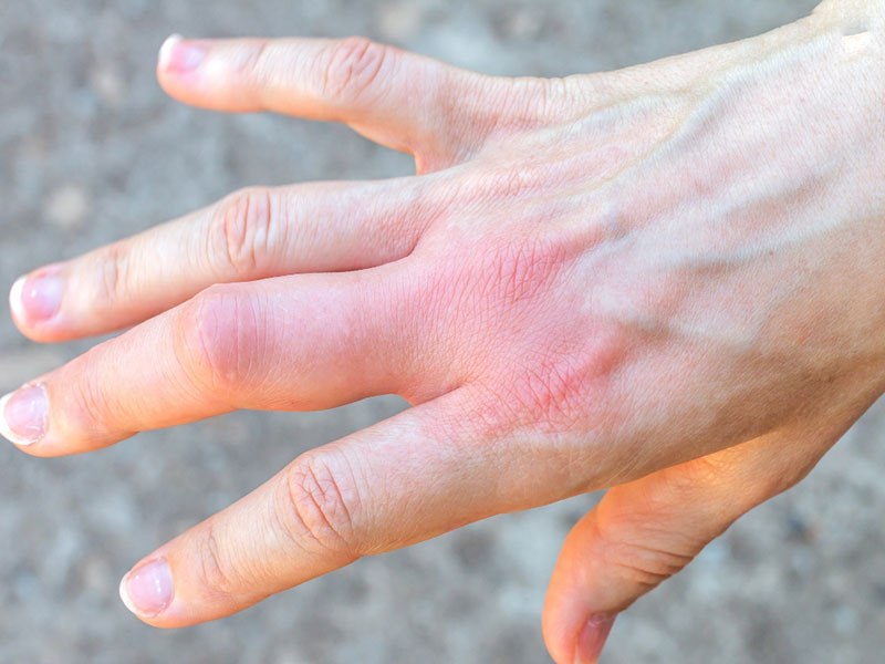 Triệu chứng đau khớp ngón tay thường gặp