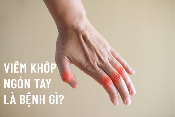 Viêm khớp ngón tay