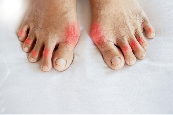 Khớp bị sưng do viêm khớp dạng thấp