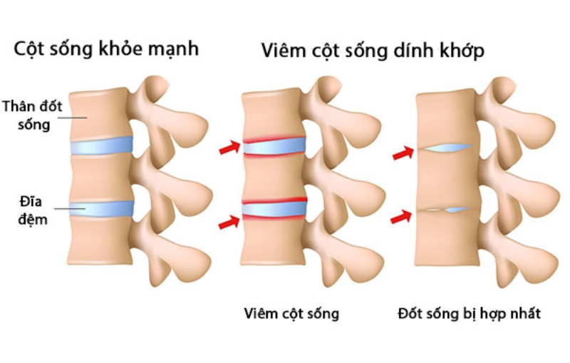 Nguyên nhân gây bệnh thấp khớp