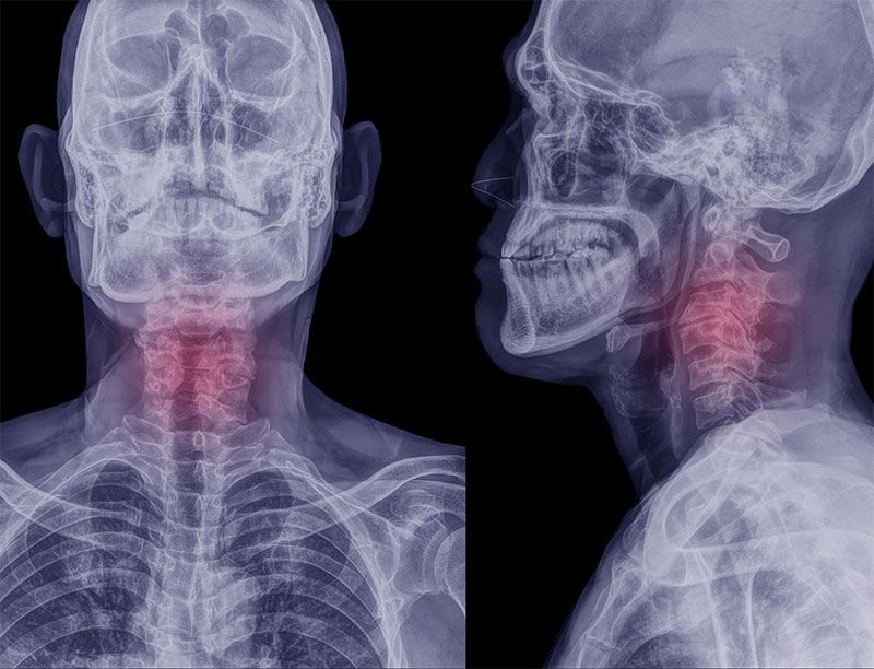 Triệu chứng gai đốt sống cổ C5 C6