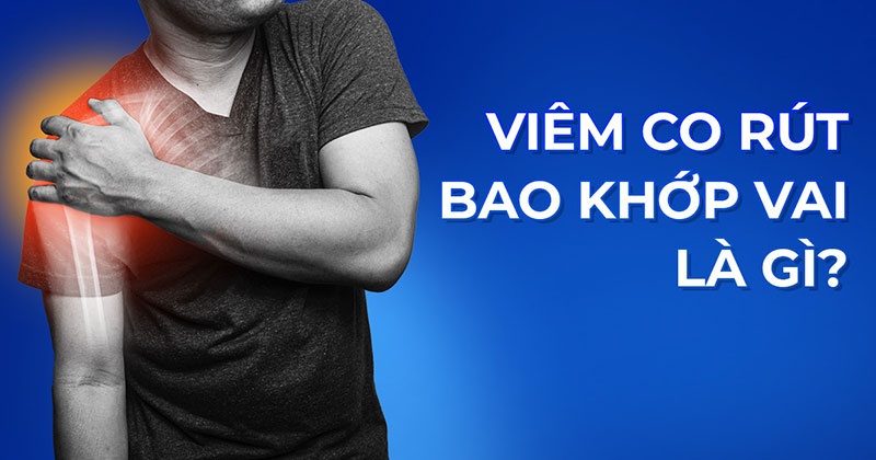 Viêm co rút bao khớp vai: Nguyên nhân, dấu hiệu và cách cải thiện