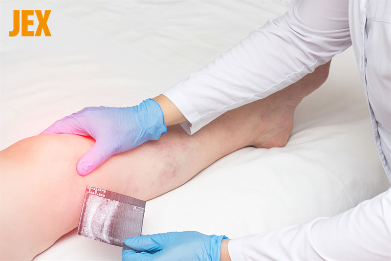 Viêm bao hoạt dịch gây đau nhức khớp gối