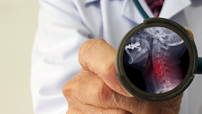 Chẩn đoán thoái hóa đốt sống cổ chèn ép