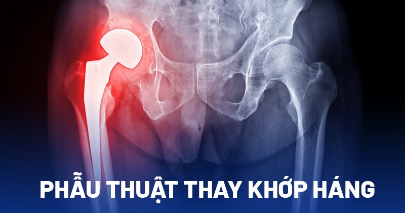Phẫu thuật thay khớp háng nhân tạo là gì?