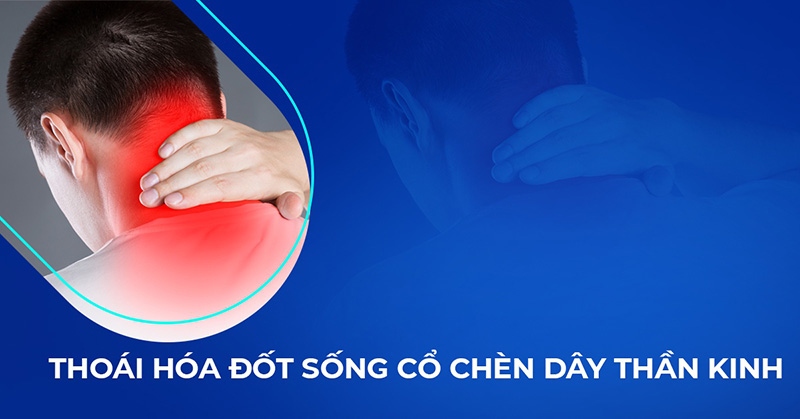Thoái hóa đốt sống cổ chèn ép dâu thần kinh