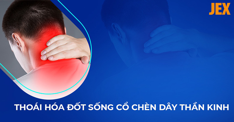 Thoái hóa đốt sống cổ chèn dây thần kinh: Nguyên nhân do đâu?